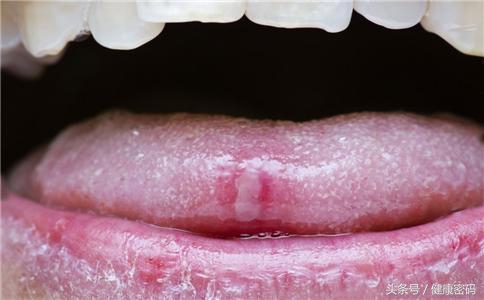 口腔溃疡口水流出来导致嘴边溃烂,牙龈内侧口腔溃疡