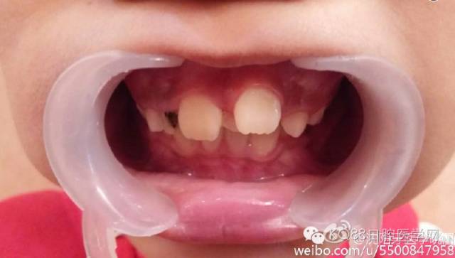 小孩的牙齿怎么会长两层,小孩怎么才能长出好看牙齿