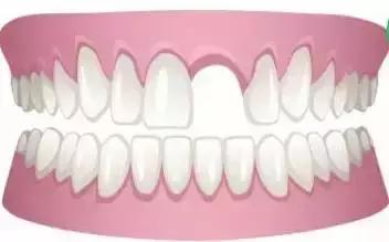 牙中间有缝怎么办,前牙有缝修复