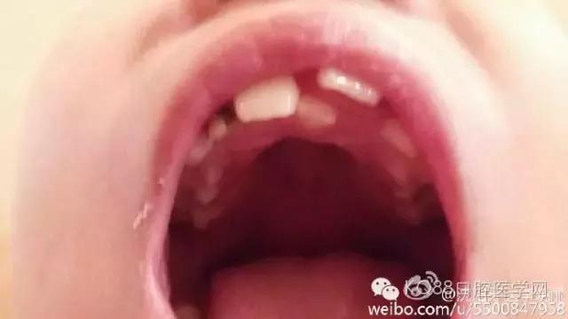小孩的牙齿怎么会长两层,小孩怎么才能长出好看牙齿
