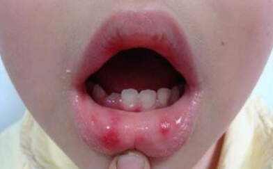 儿童疱疹病毒怎么治疗根除,如何预防儿童单纯疱疹