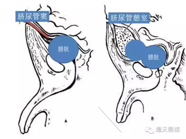 脐部感染流脓,脐部渗血的原因及护理