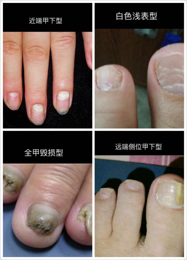 两岁指甲脱落怎么看是不是灰指甲,儿童手指指甲边缘和肉分离怎么办