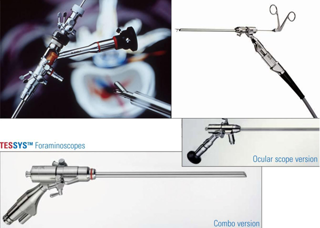 微创手术治疗腰椎间盘突出成功率,目前最热门腰椎微创技术椎间孔镜