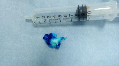 微创手术治疗腰椎间盘突出成功率,目前最热门腰椎微创技术椎间孔镜