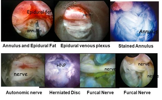 微创手术治疗腰椎间盘突出成功率,目前最热门腰椎微创技术椎间孔镜