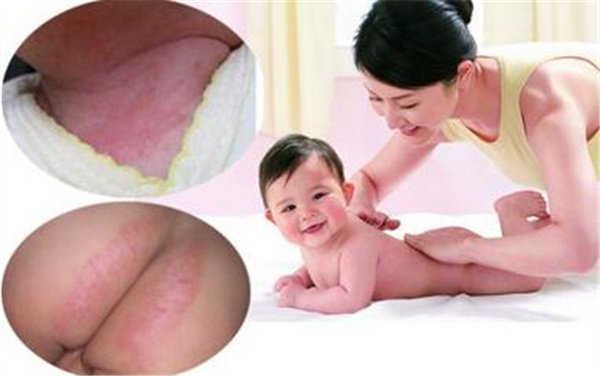 宝宝的尿布疹反复发作,宝宝有尿布疹和颈部皮疹