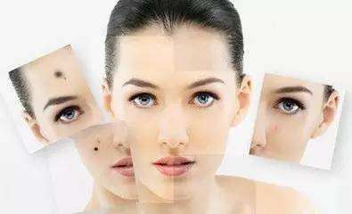 痣该不该祛,有痣需要去掉吗