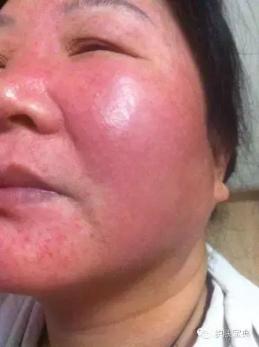 有螨虫的皮肤该怎么处理,螨虫真的和皮肤没有关系吗