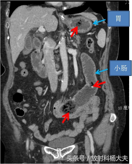 ​吃下2块钱的柿子，却要去医院花两千块把它从肠子里弄出来