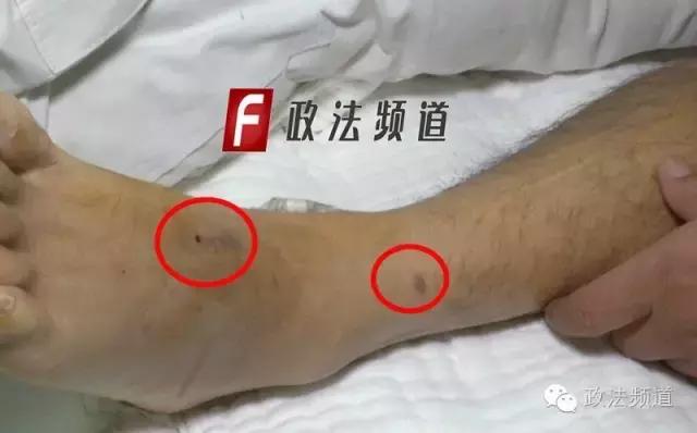 男子骑摩托被蜜蜂蜇,男子被马蜂蜇伤民警紧急救助