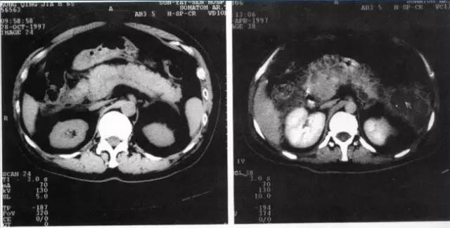 “李逵/李鬼”之真假胰腺炎