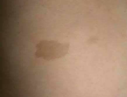 宝宝身上有哪些胎记,有胎记的小孩儿是不是天使