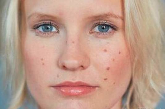 涨知识女孩子,如何知道自己是不是雄激素过多呢