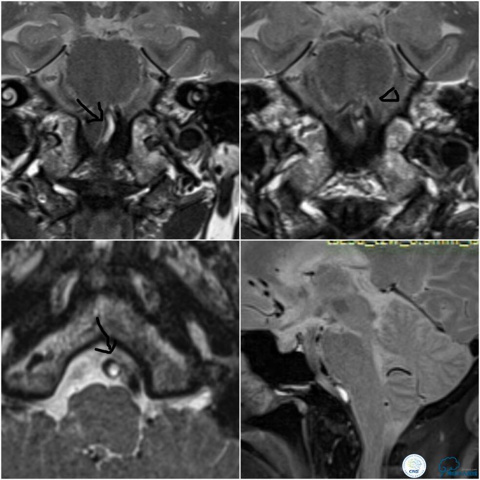 天坛周记|右椎动脉V4段慢性闭塞血管内介入治疗再通一例