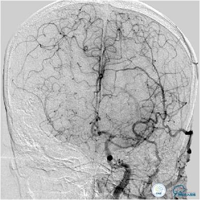 大脑左侧中动脉是主动脉吗,什么是左侧大脑中动脉代偿供血