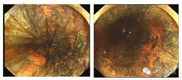 6个精彩病例带你领略早期食管癌的内镜下诊治