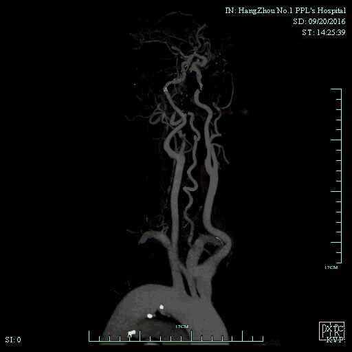 一例颈动脉栓塞的血管内介入治疗