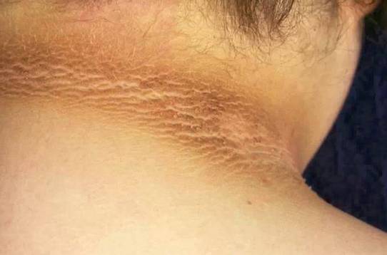 涨知识女孩子,如何知道自己是不是雄激素过多呢