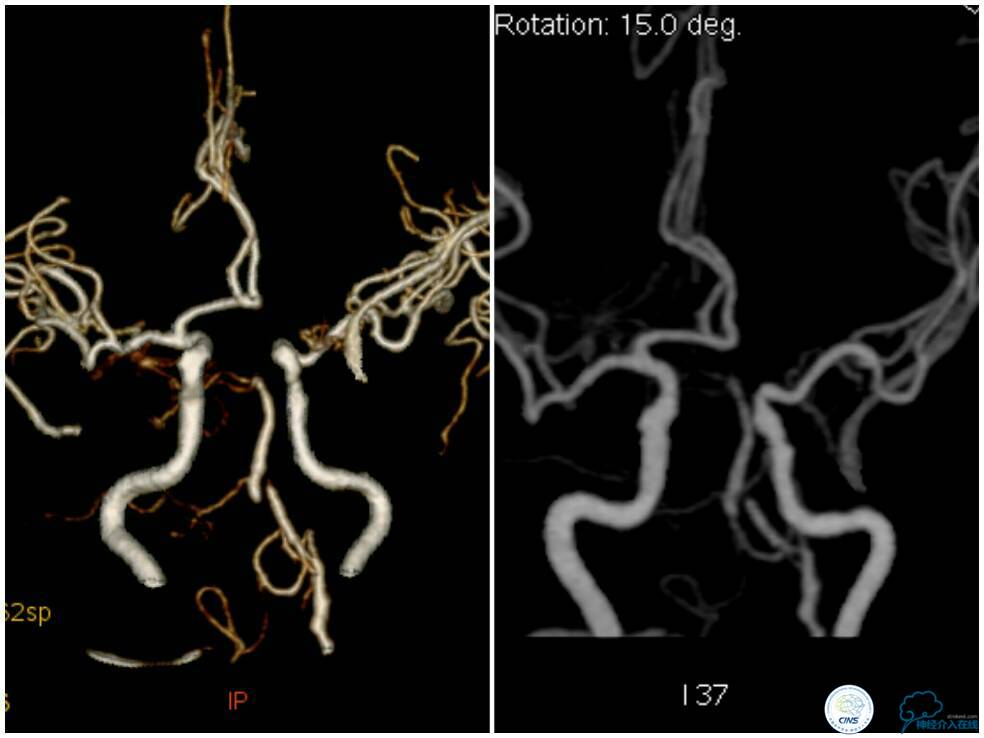 天坛周记|右椎动脉V4段慢性闭塞血管内介入治疗再通一例