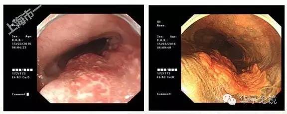 6个精彩病例带你领略早期食管癌的内镜下诊治