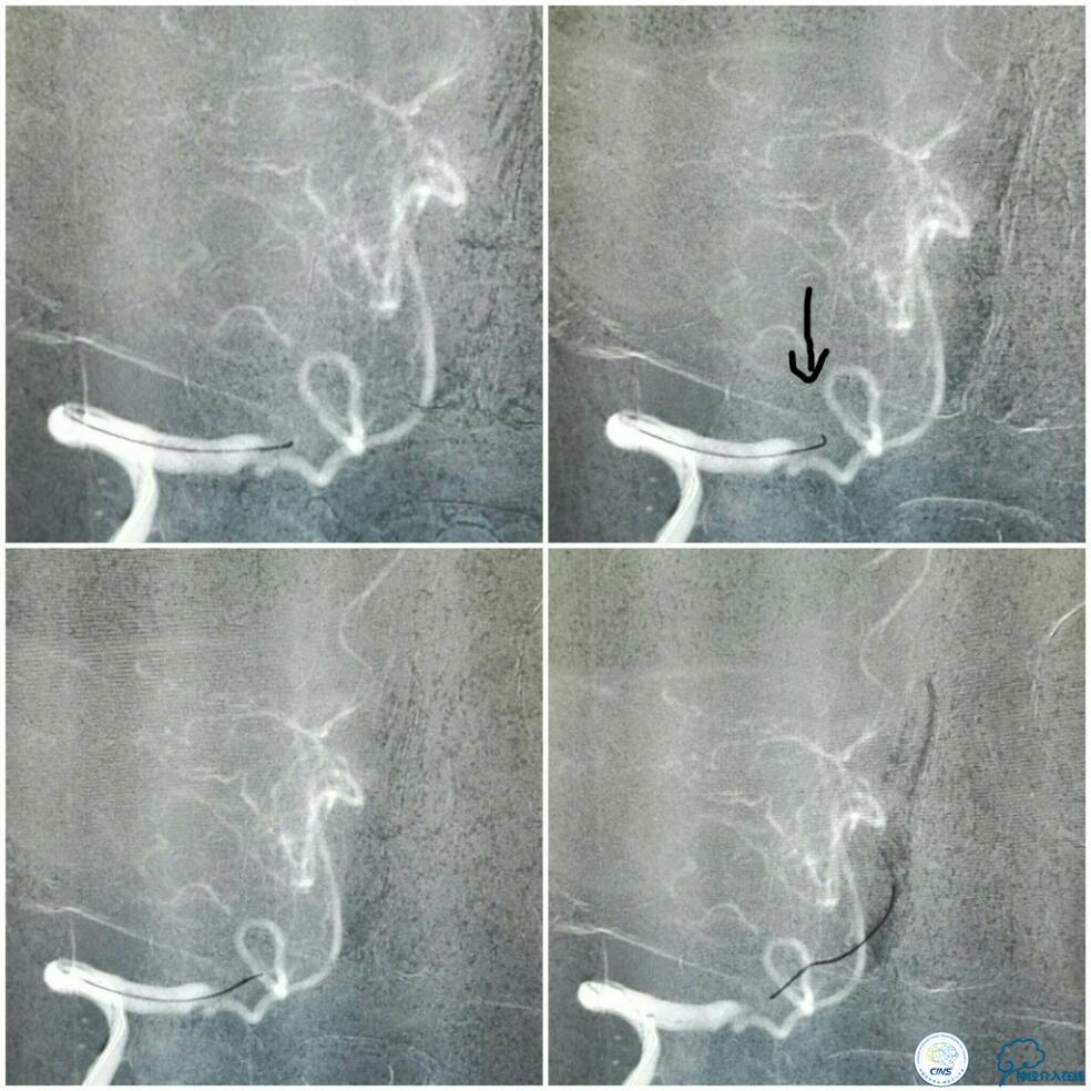 天坛周记|右椎动脉V4段慢性闭塞血管内介入治疗再通一例
