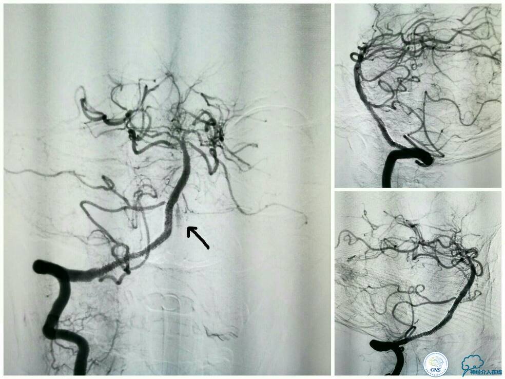 天坛周记|右椎动脉V4段慢性闭塞血管内介入治疗再通一例
