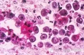 你听说过“吃脑虫”吗?男子患病十几天病逝...原来就因为他做了这件事,大连的小伙伴也要当心!