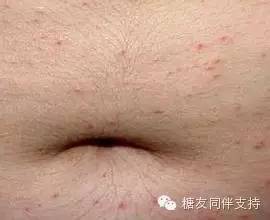 糖尿病友预防肾病,听台湾卫都师的建议