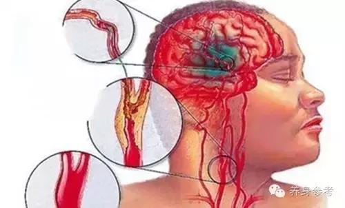 讲解脑血栓疾病的4大预防绝招,脑血栓患者秋天要注意什么