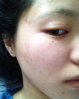 妙招姐解决痘印,为什么痘印老是顽固不化