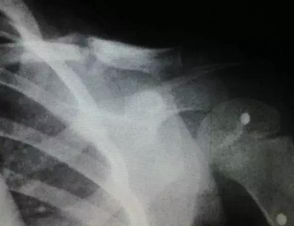 小孩锁骨骨折最好的治疗方法,锁骨远端骨折手术多久能恢复正常