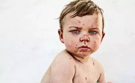 宝宝长水痘妈妈应该怎样预防,四个月宝宝出水痘有什么并发症