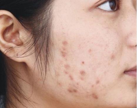 痘痘印快速消除方法,怎样快速去除淤血痘印