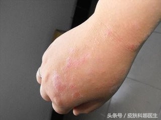 外阴湿疹瘙痒中药治疗,瘙痒性湿疹妇科