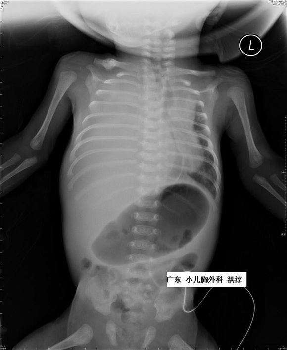 胎儿胸腔积液自己吸收的几率高吗,胎儿胸腔积液9mm严重吗