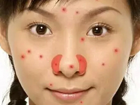 脸上长痘部位解析,脸上长痘位置与脏器对照