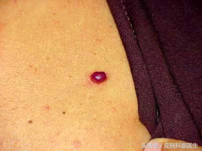长鲜红斑痣民间中医能治吗,皮肤上像红痣的红疙瘩可以刺破吗