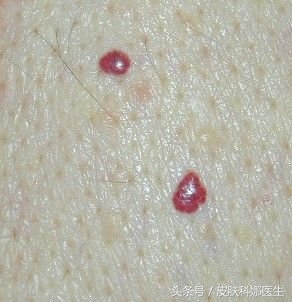 长鲜红斑痣民间中医能治吗,皮肤上像红痣的红疙瘩可以刺破吗