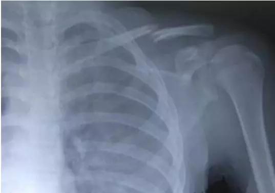 小孩锁骨骨折最好的治疗方法,锁骨远端骨折手术多久能恢复正常