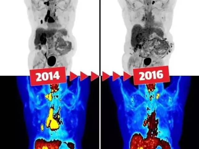 不用化疗就能治愈肺癌,澳洲医学界再传好消息!