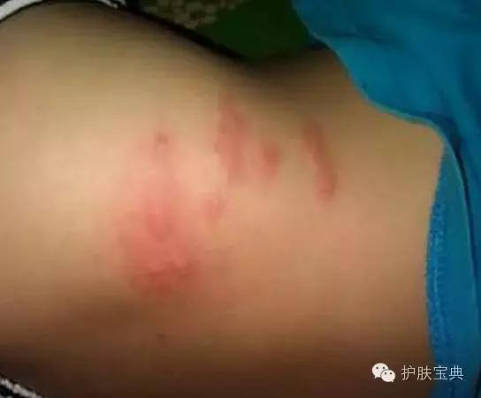 有螨虫的皮肤该怎么处理,螨虫真的和皮肤没有关系吗