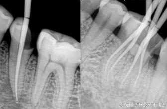 一根针扎进眼珠里会怎么样,一根针放进什么地方容易融化