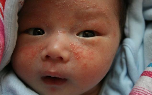 湿疹10年治愈方法,湿疹的十个阶段