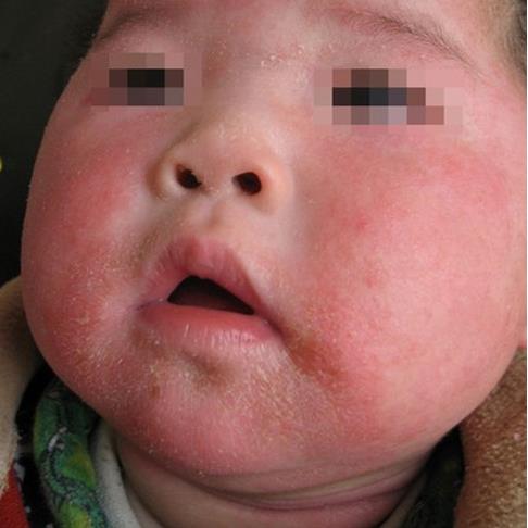 湿疹10年治愈方法,湿疹的十个阶段