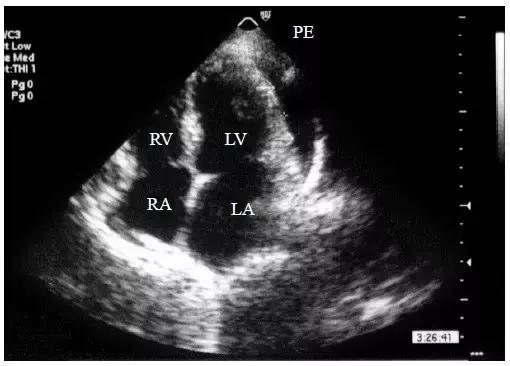 超声诊断心包腔积液,心包积液的超声诊断与鉴别
