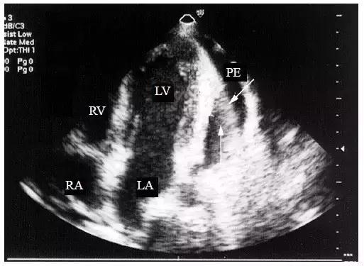 超声诊断心包腔积液,心包积液的超声诊断与鉴别