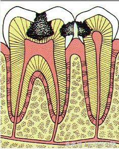 满口蛀牙的图片,满口蛀牙毁终身