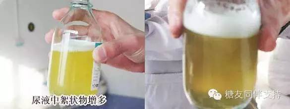 糖尿病友预防肾病,听台湾卫都师的建议