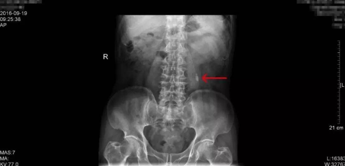 23岁男性泌尿道结石治疗方法,中医治疗输尿管结石独特方法